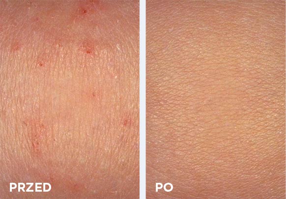 Porównanie skóry przed i po zastosowaniu Atoderm AD Intensive Baume