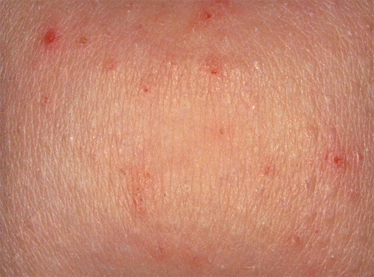 Skóra przed zastosowaniem Atoderm AD Intensive Baume